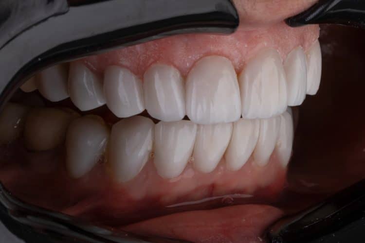 a person's mouth with teeth