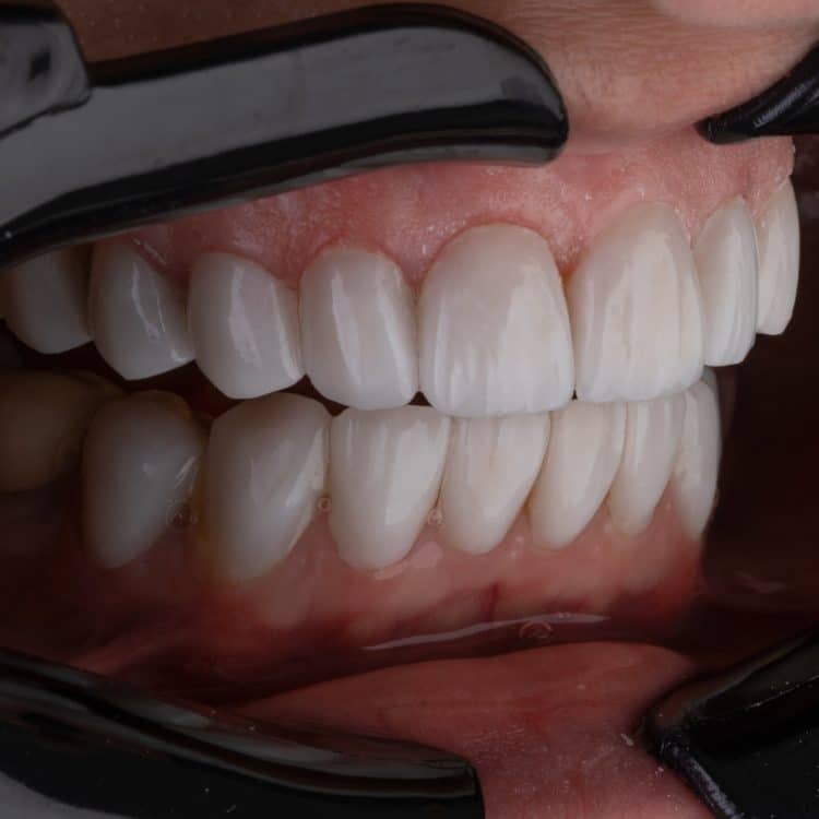 a person's mouth with teeth